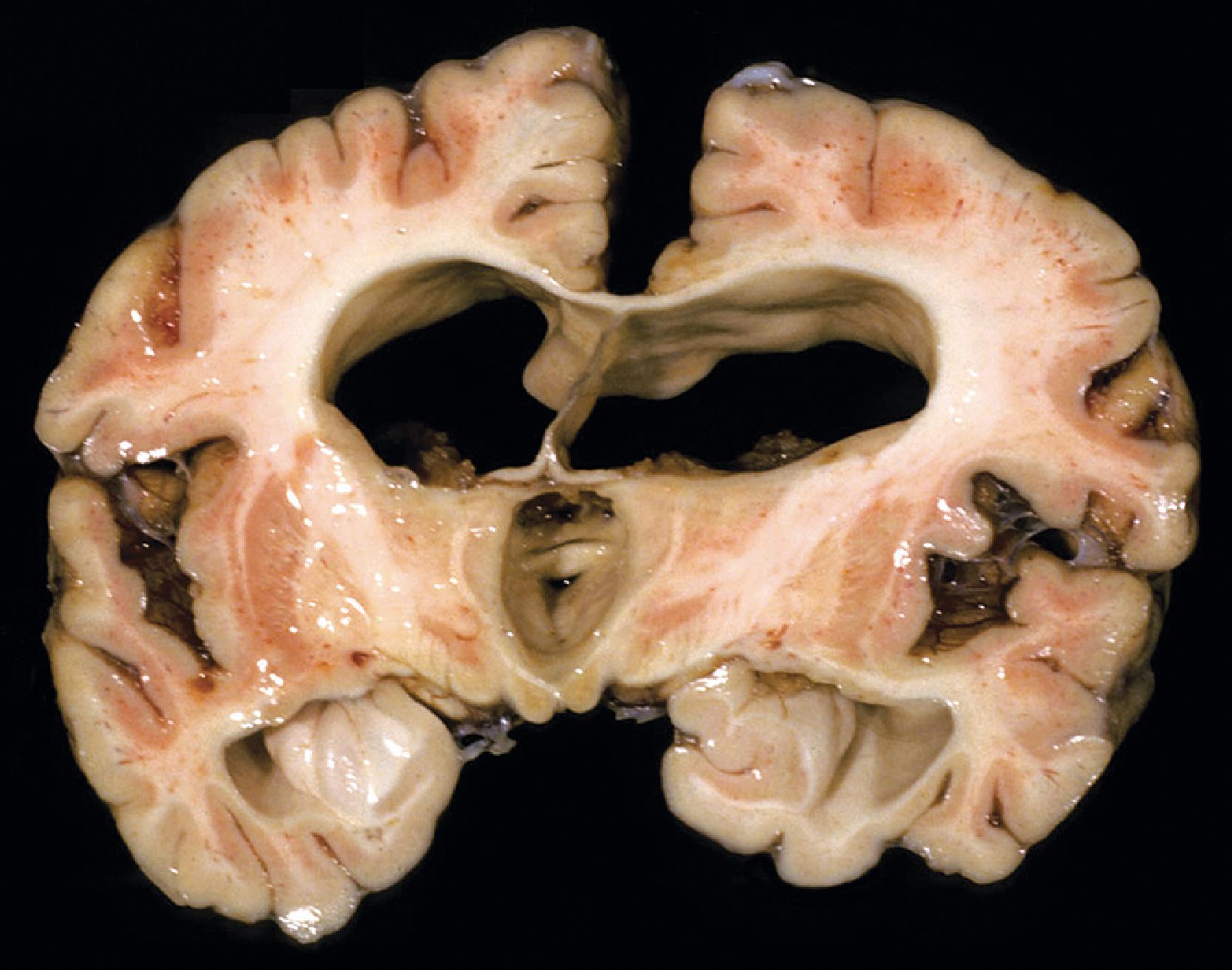 FIGure 8.28, Hydrocephalus in Hurler syndrome.