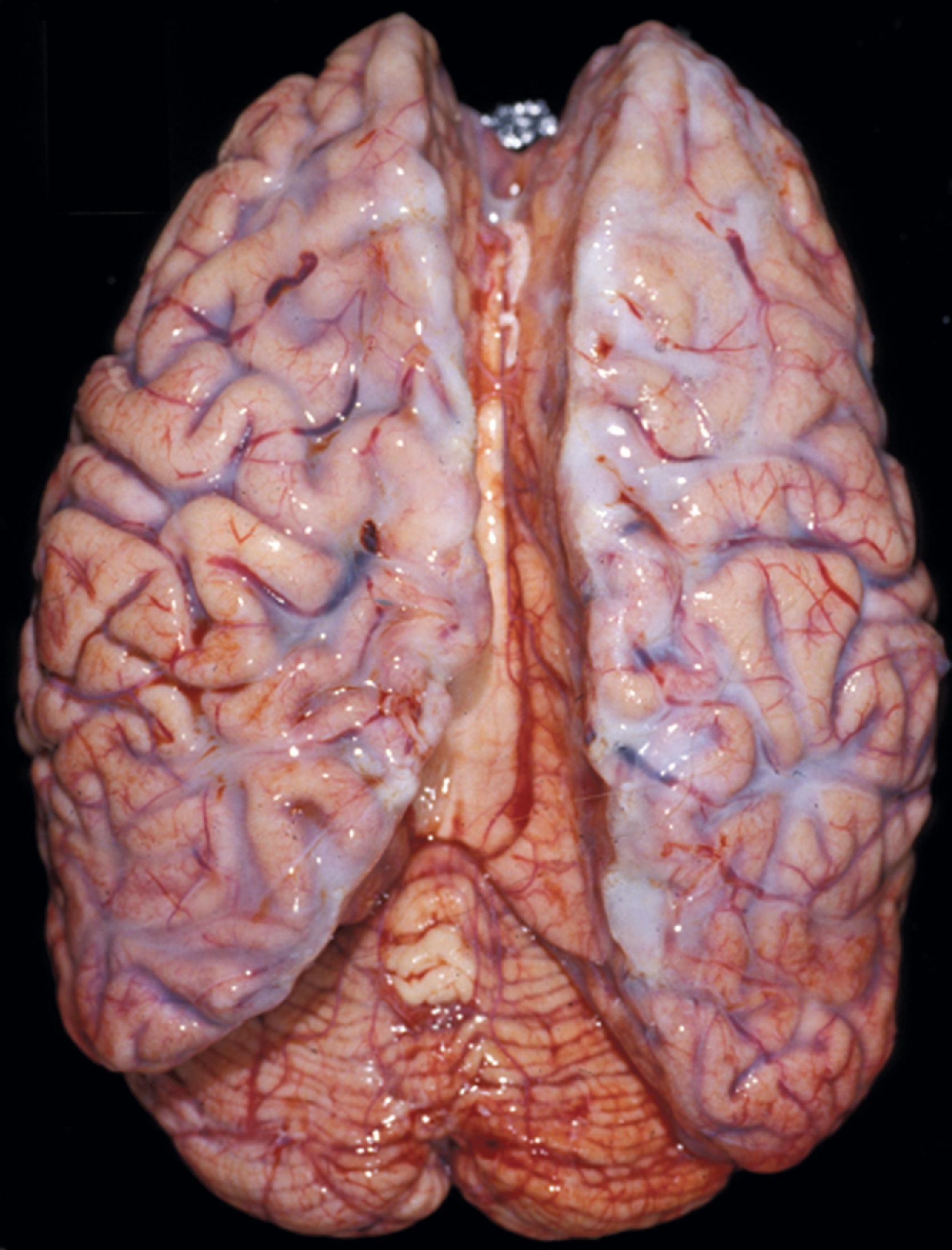 FIGure 8.29, Meningeal opacity in mucopolysaccharidosis.