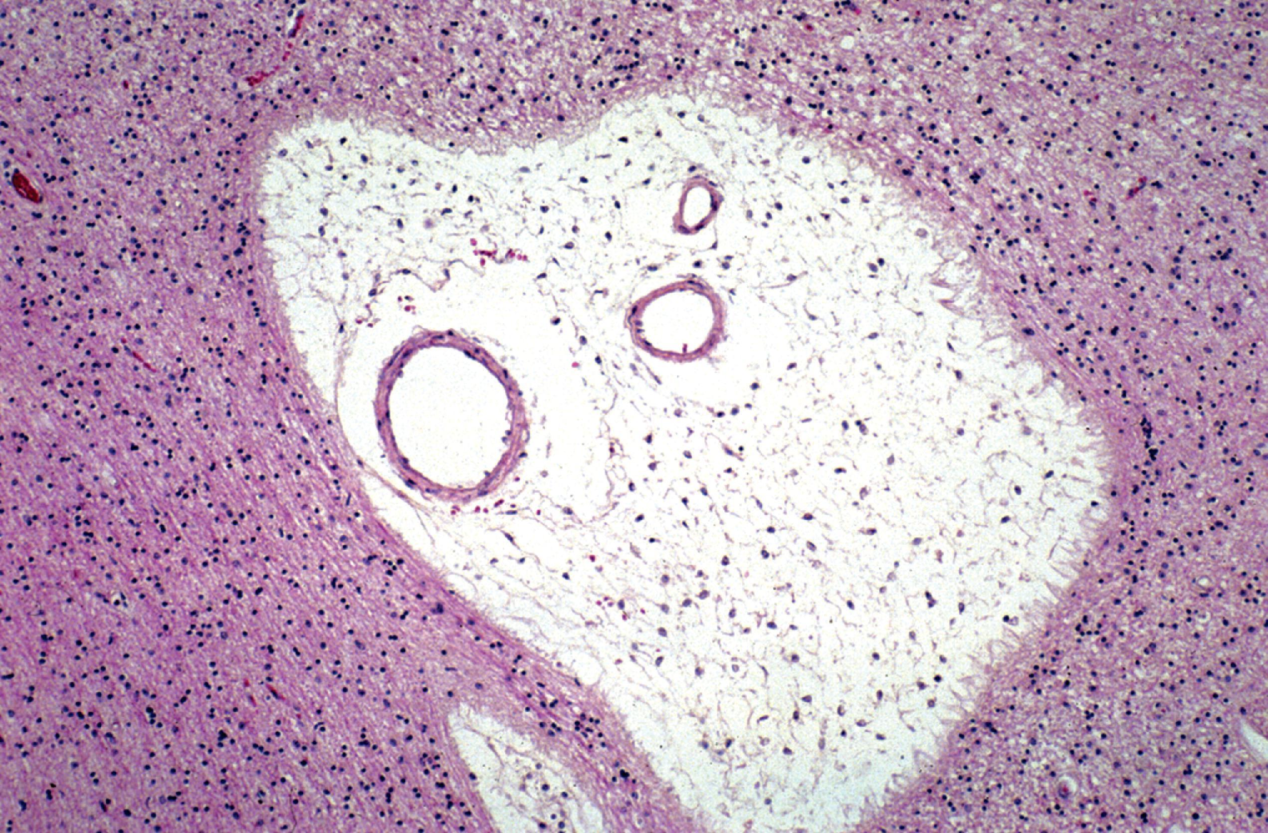 FIGure 8.30, Expansion of perivascular CNS spaces due to mucopolysaccharidosis deposition in Hurler syndrome.