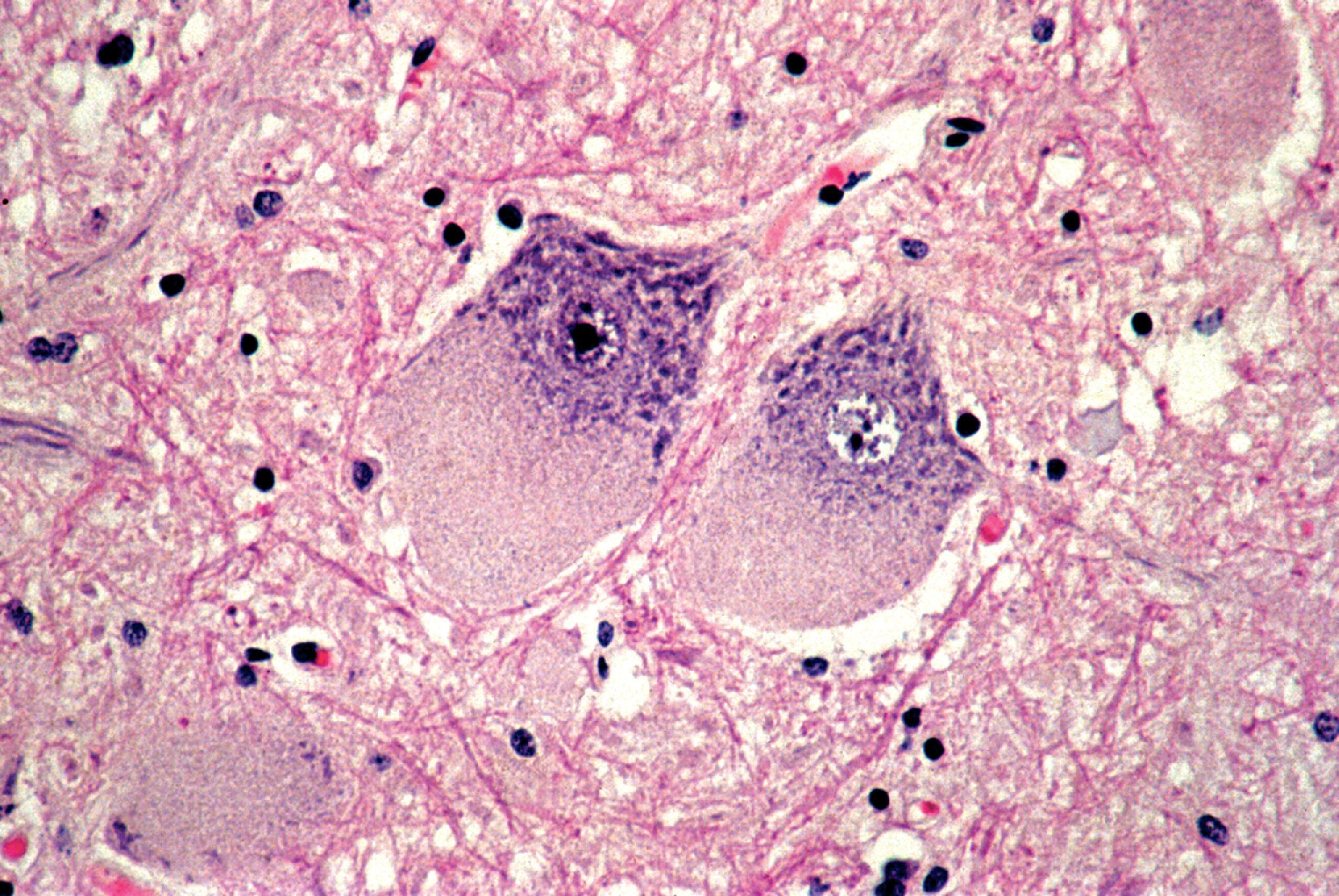 FIGure 8.3, Neuronal ballooning in Niemann-Pick type C disease.