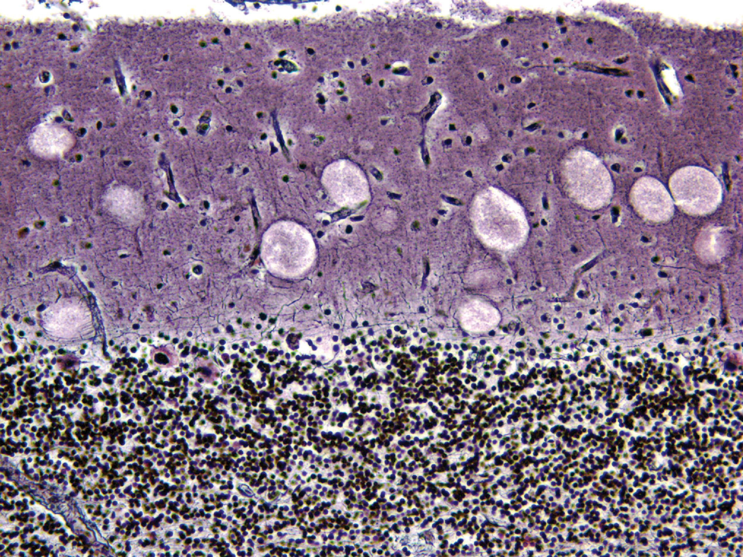 FIGure 8.31, Expansion of Purkinje cell dendrites due to ganglioside storage in Sanfilippo C syndrome.