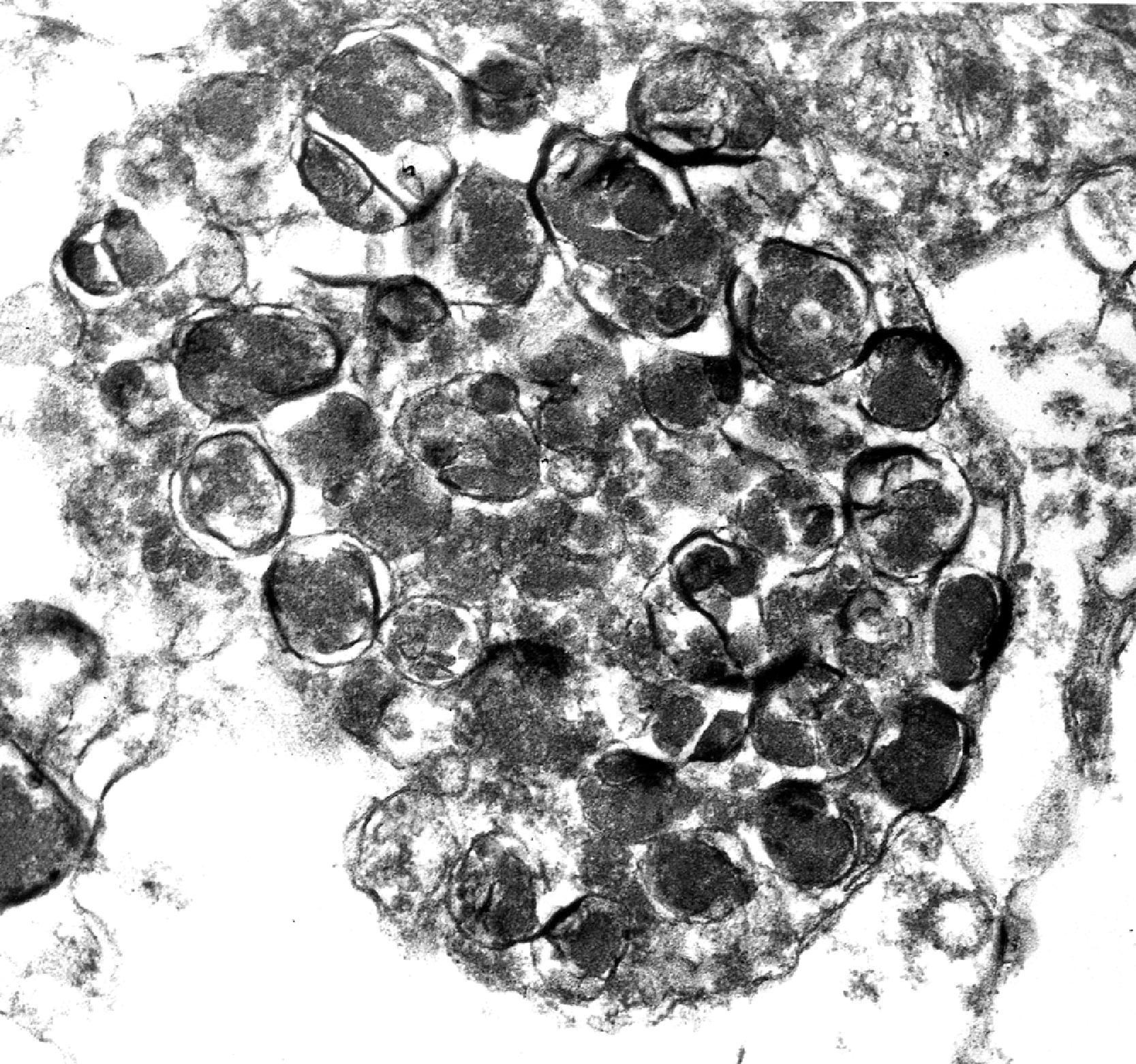 FIGure 8.32, Granular osmophilic deposits in adult neuronal ceroid lipofuscinosis.