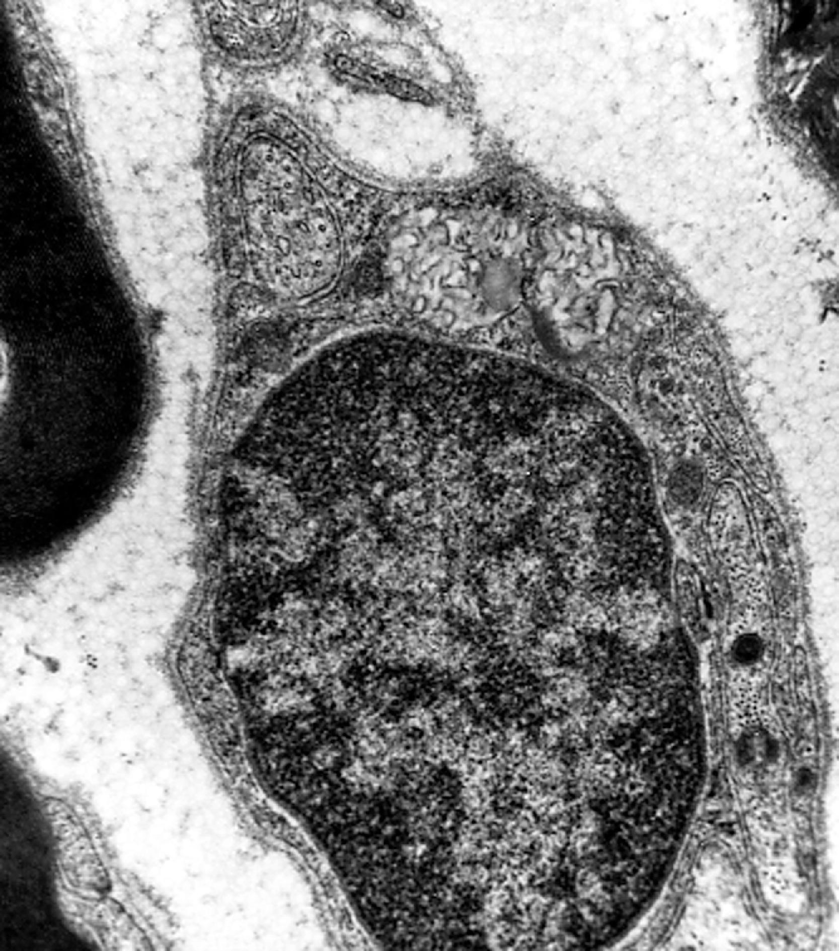 FIGure 8.33, Curvilinear bodies in a Schwann cell in late infantile neuronal ceroid lipofuscinosis.