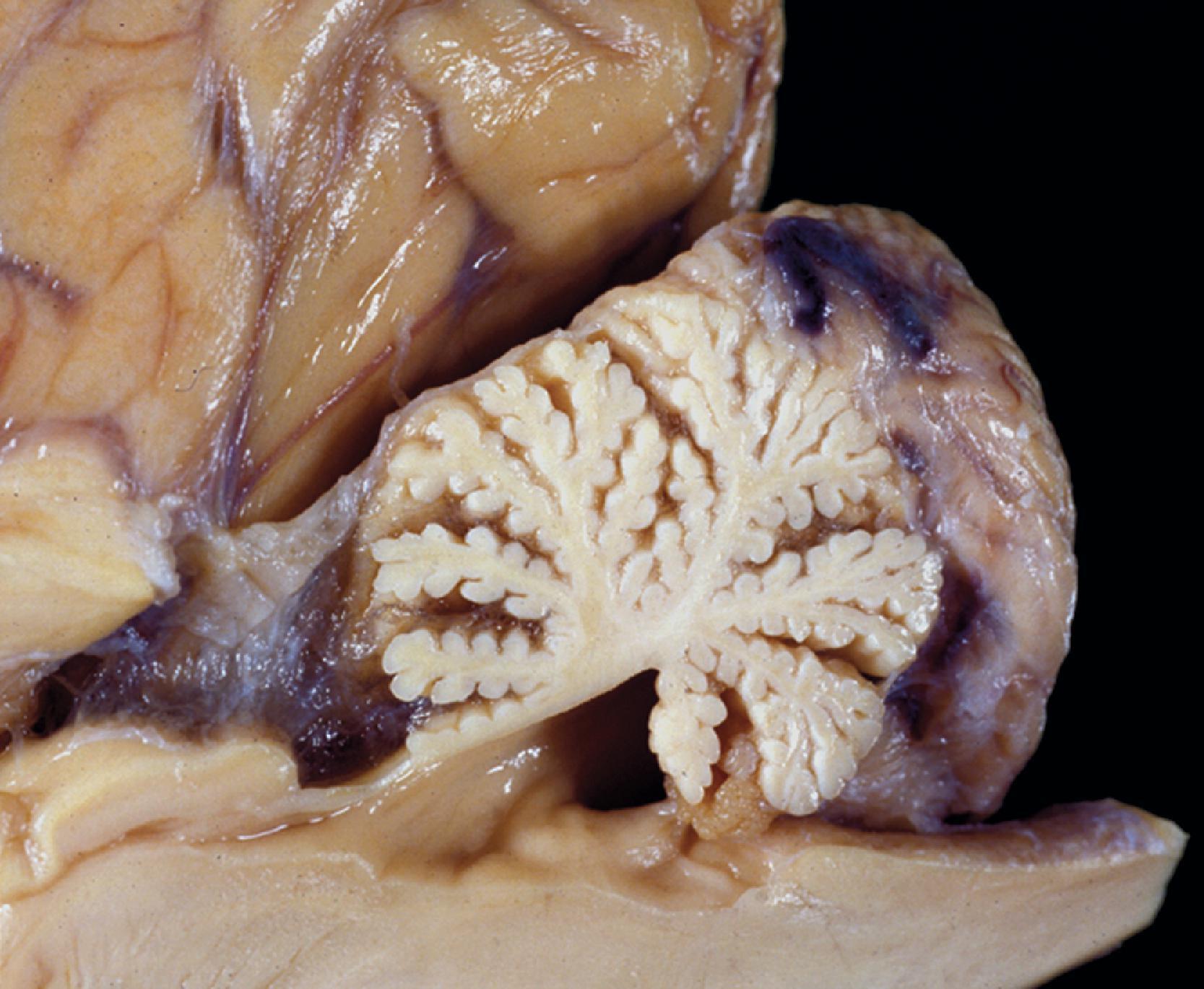 FIGure 8.34, Cerebellar atrophy in late infantile neuronal ceroid lipofuscinosis.