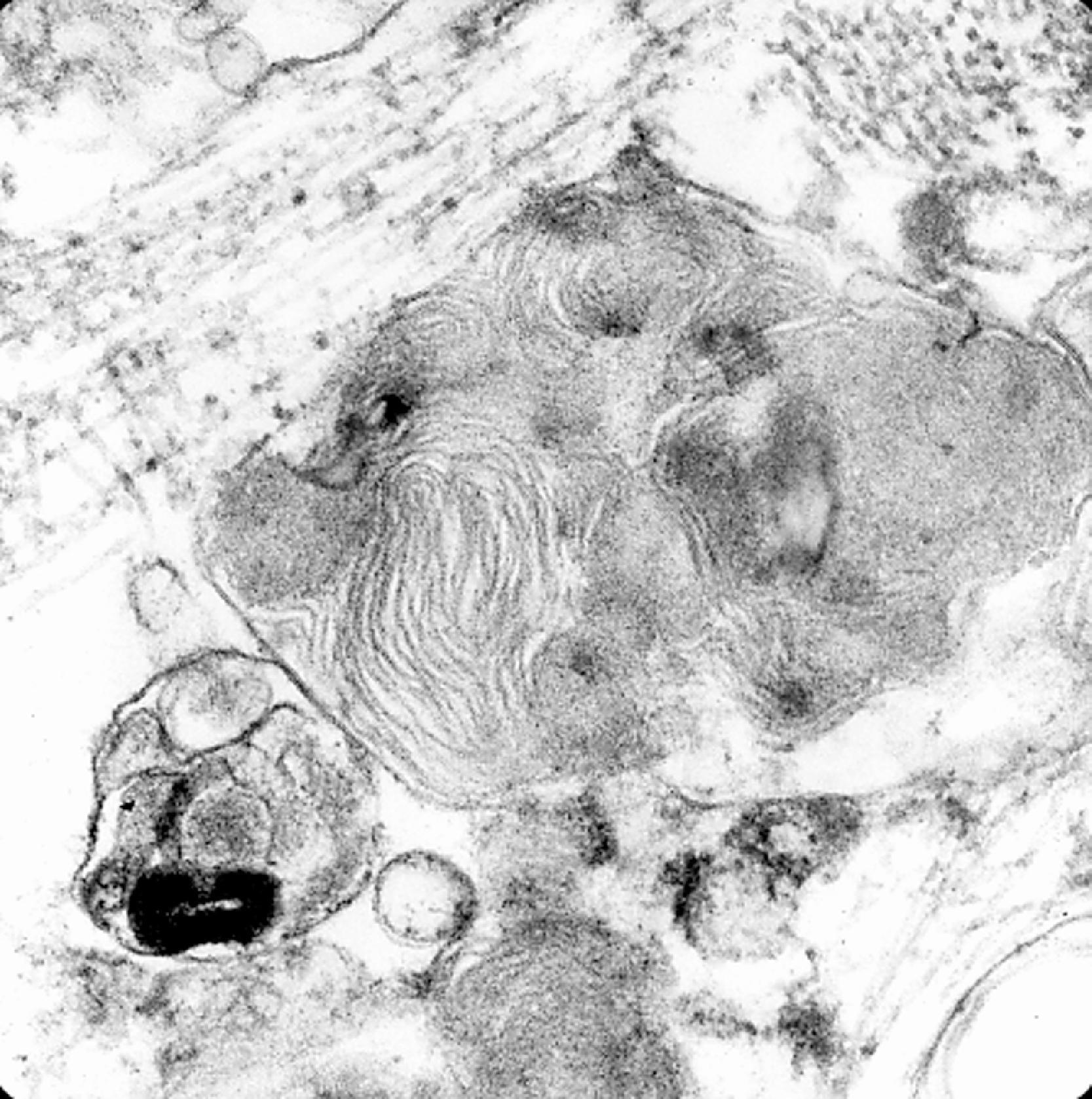 FIGure 8.35, Fingerprint profiles in juvenile neuronal ceroid lipofuscinosis.