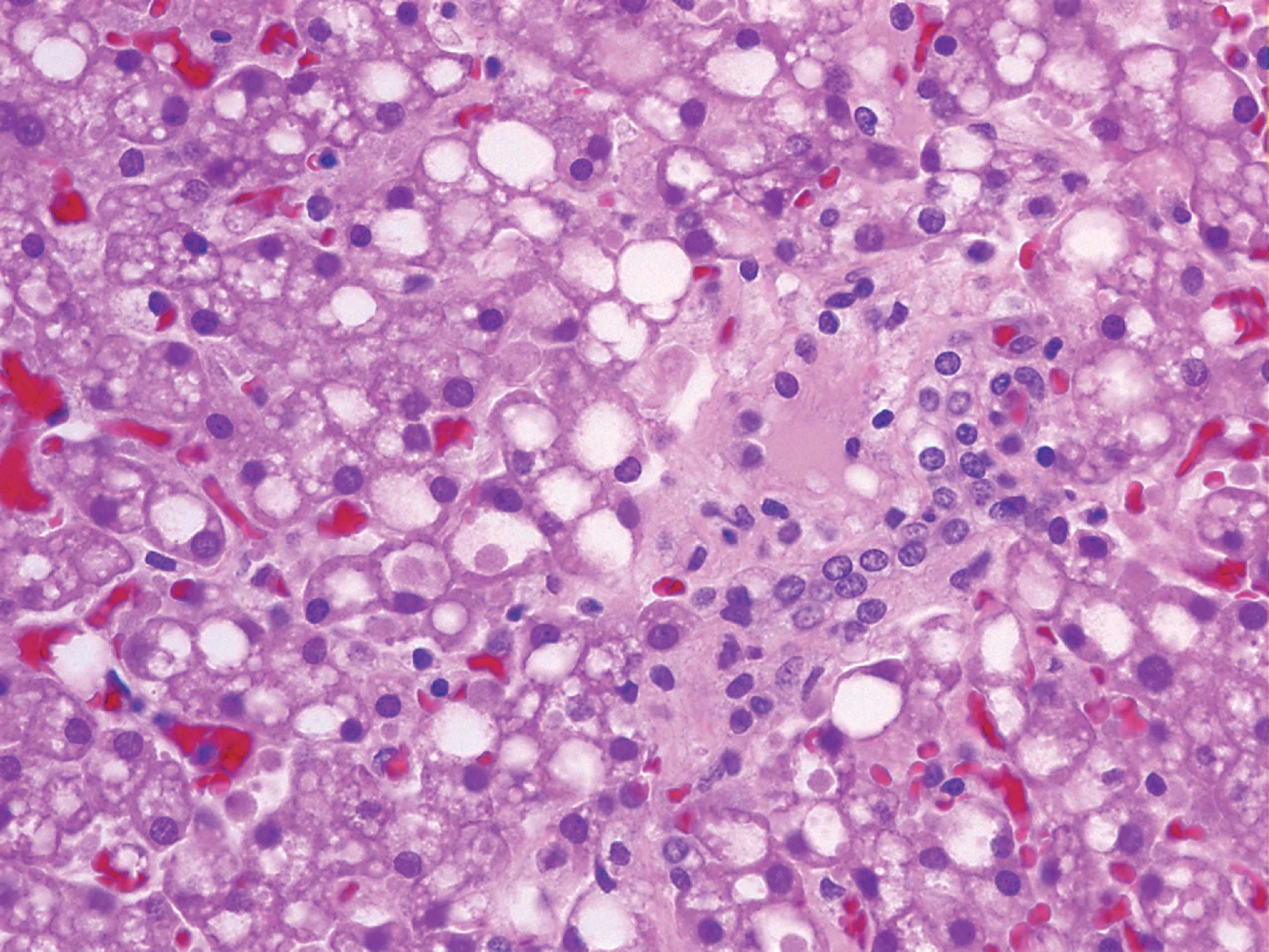 FIGure 8.4, Distended clear hepatocytes in mucopolysaccharidosis.