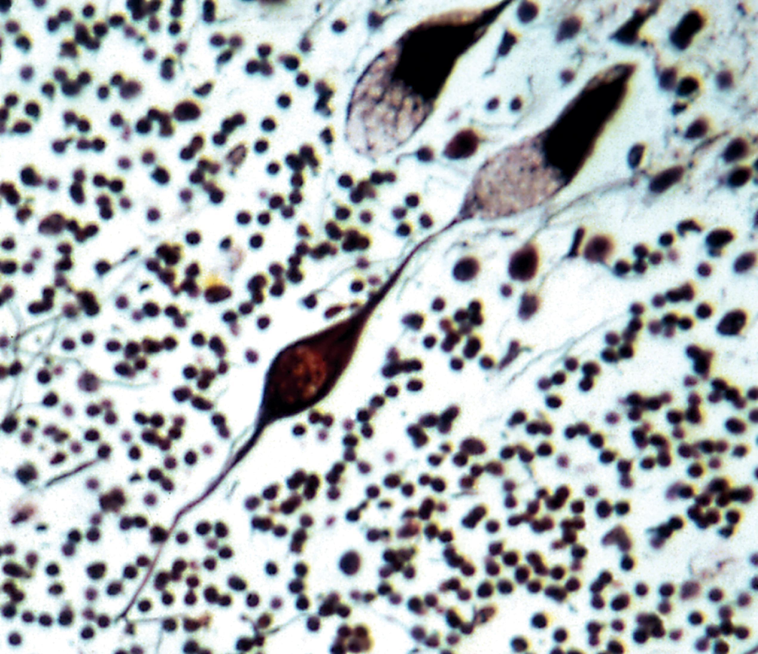 FIGure 8.5, Torpedo-like swelling of Purkinje cell dendrite in GM 1 gangliosidosis.