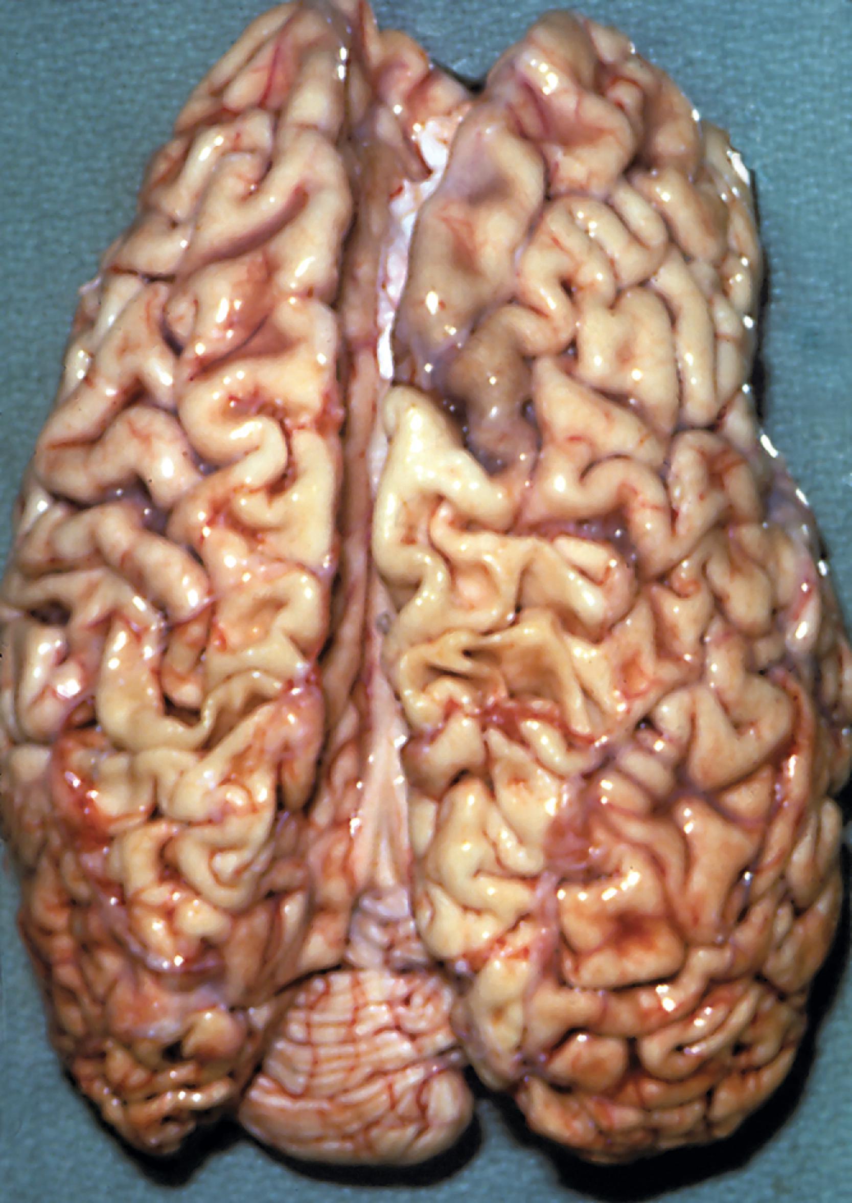 FIGure 8.6, Cerebral atrophy in GM 1 gangliosidosis.