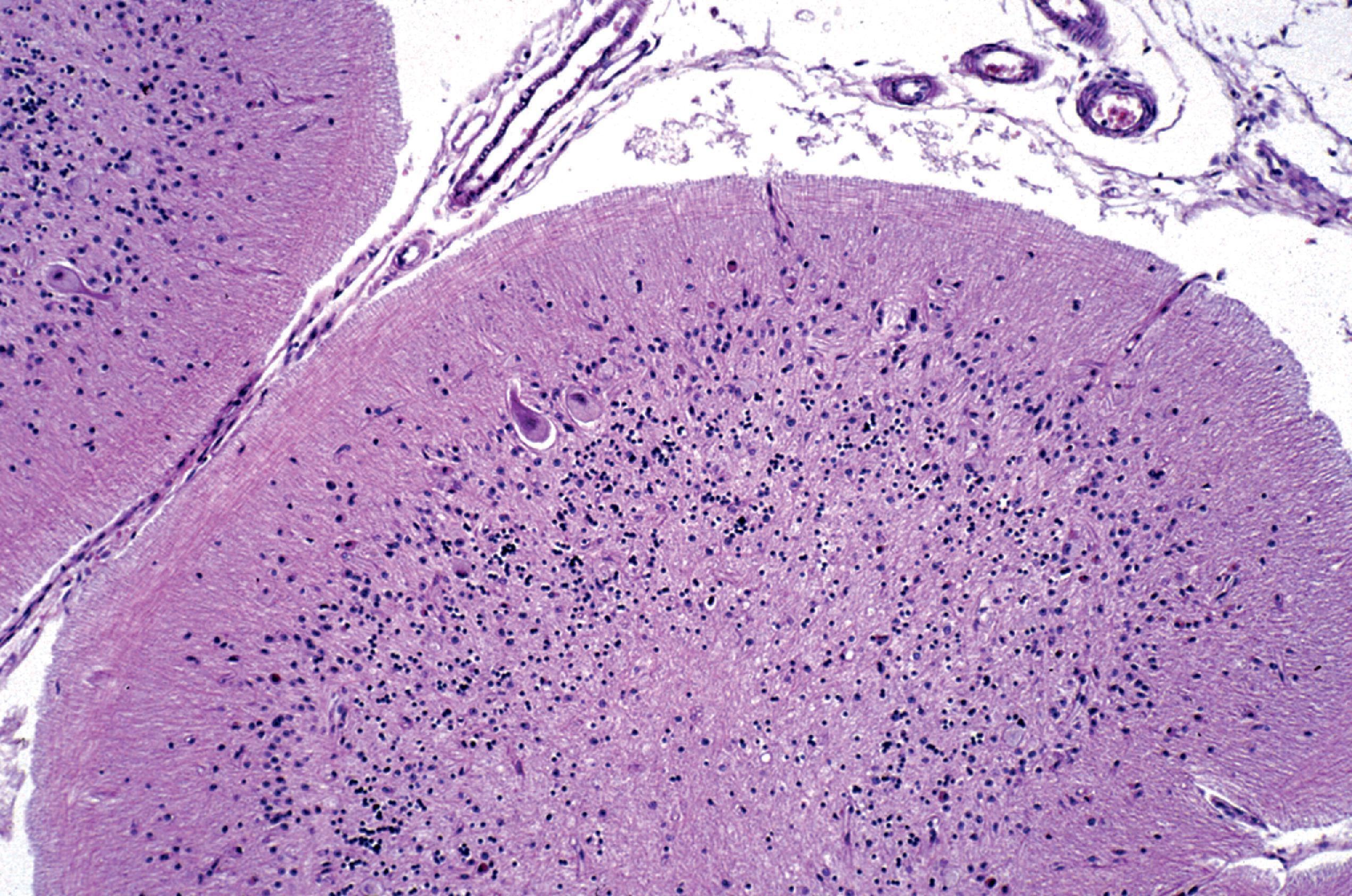 FIGure 8.7, Cerebellar atrophy in GM 1 gangliosidosis.