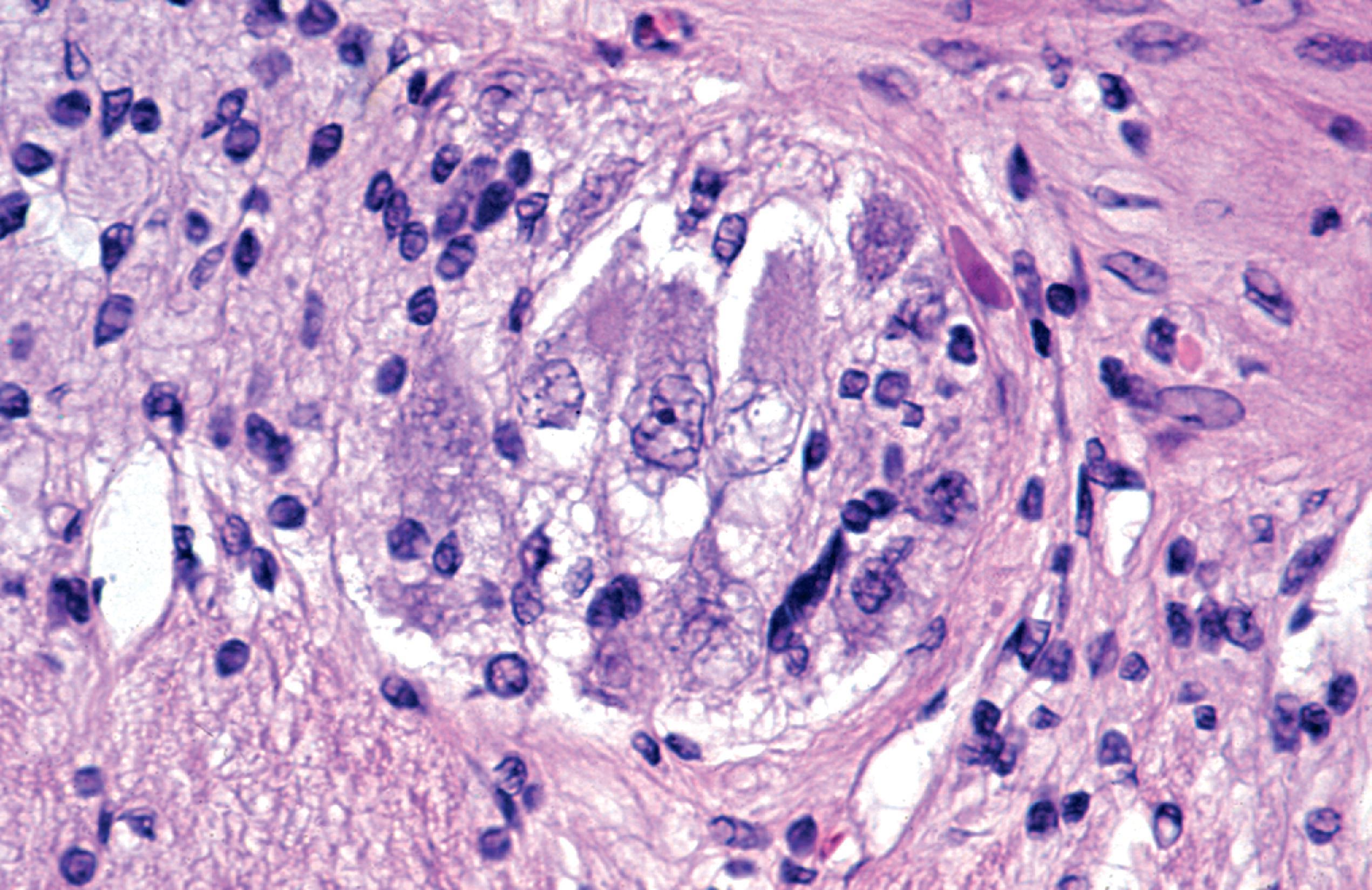 FIGure 8.8, Distended vacuolated ganglion cells in Auerbach plexus in GM 1 gangliosidosis.