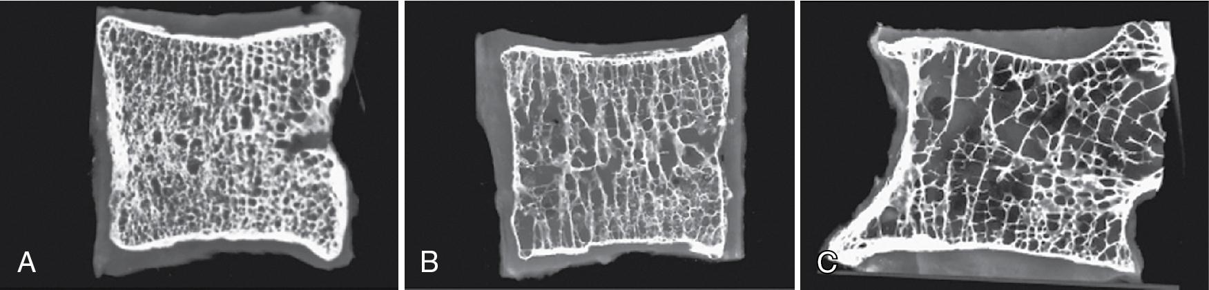 Fig. 64.5, Specimen radiographs of 2 mm slices through the vertebral body of T2. (A) The first specimen represents normal bone texture, density, and pattern. (B) The second specimen shows a moderate degree of osteopenia, with accentuation of the vertical trabeculae and selective loss of the horizontal trabeculae. (C) The third specimen shows severe osteoporosis, with irregular thin trabeculae and partial central collapse of the superior endplate.