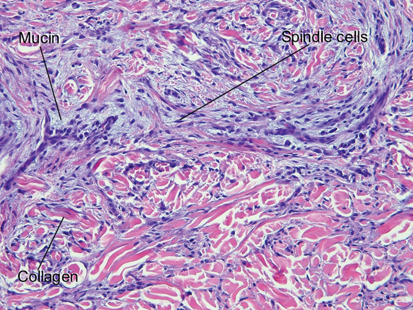 Fig. 14.6, Scleromyxedema