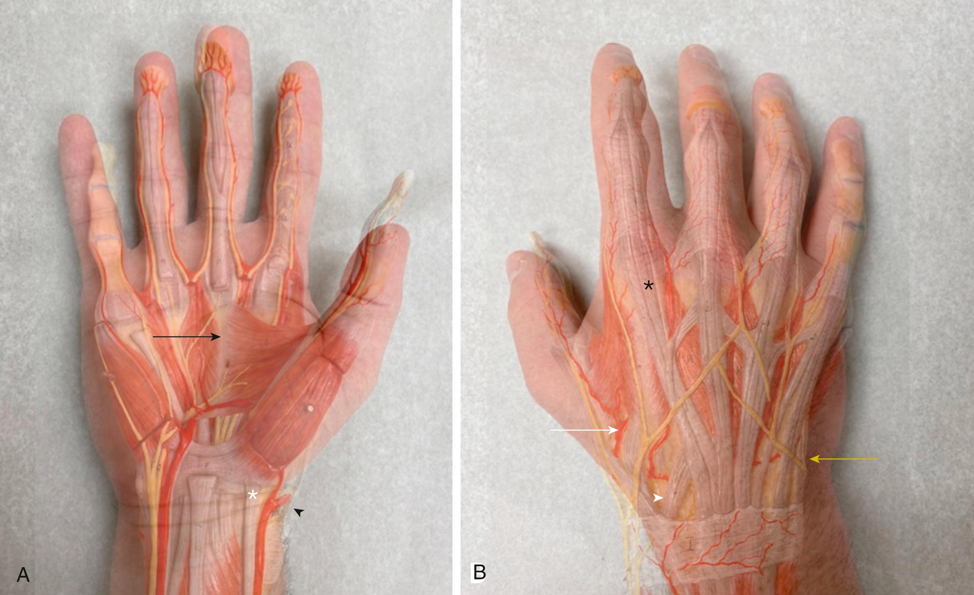 Fig. 74.1, Anatomy of the metacarpals with the extrinsic deforming forces highlighted. (A) The flexor carpi radialis inserts onto the base of the index metacarpal (white asterisk) and the adductor pollicis transverse head (black arrow) originates from the third metacarpal and inserts onto the ulnar thumb sesamoid and proximal phalanx. The radial artery (black arrow head) division into the volar and dorsal branches at the level of the radial styloid. (B) The extensor carpi radialis longus (white arrow) and extensor carpi radialis brevis (white arrowhead) insert onto the radial base of the second and third metacarpals, respectively. The extensor carpi ulnaris inserts at the ulnar base of the fifth metacarpal (yellow arrow) . Extensor indicis proprius tendon (black asterisk) is found deep and ulnar to the extensor digitorum communis tendon.