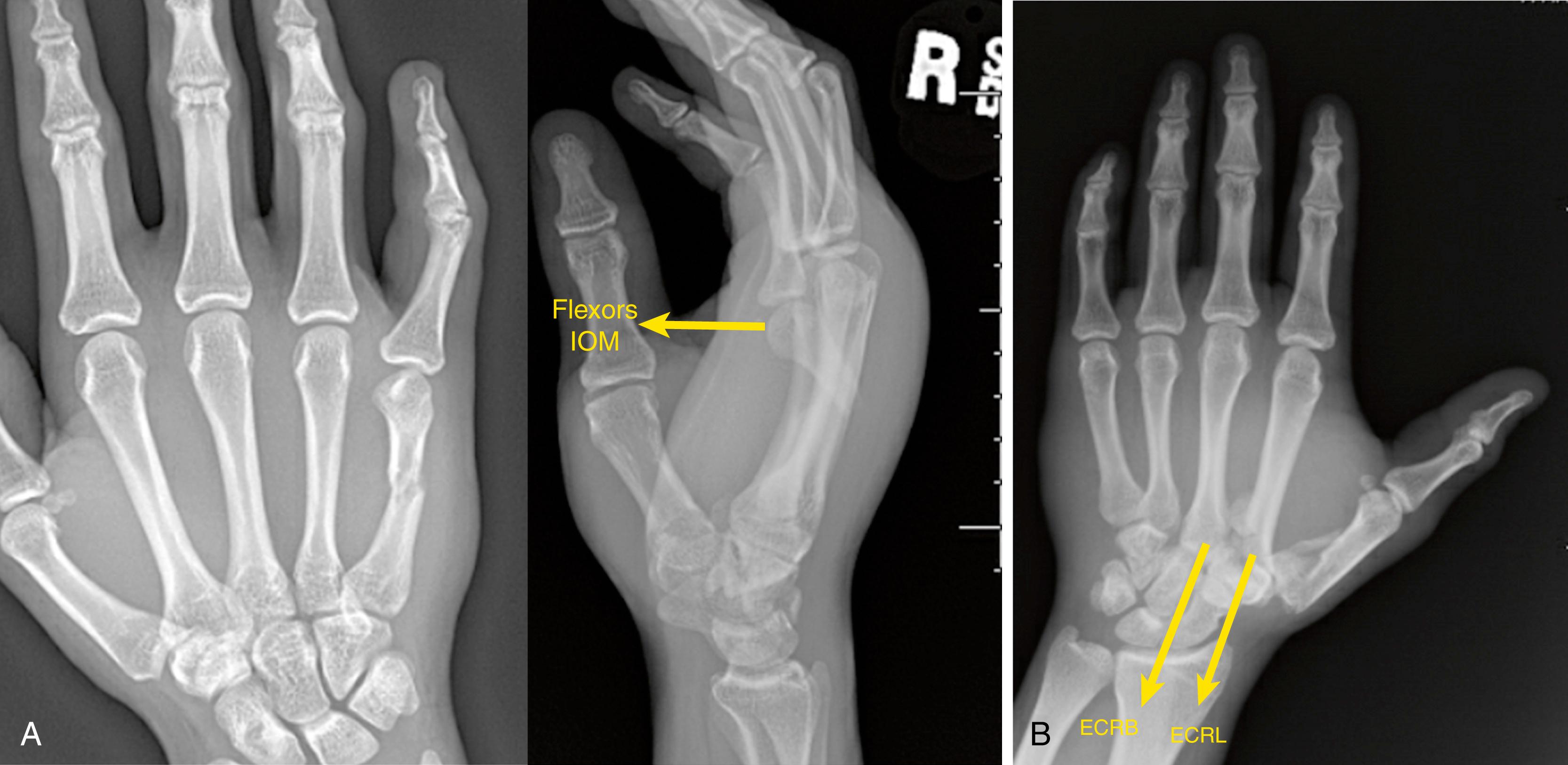 Fig. 74.3, Dorsal displacement of metacarpal base fractures involving the index and long finger. (A, B) Demonstrate a PA and lateral radiograph of a metacarpal shaft fracture with typical apex dorsal angulation and shortening. The shortening is limited by the transverse intermetacarpal ligament. ECRB , Extensor carpi radialis brevis; ECRL , extensor carpi radialis longus; IOM , interosseous muscles.