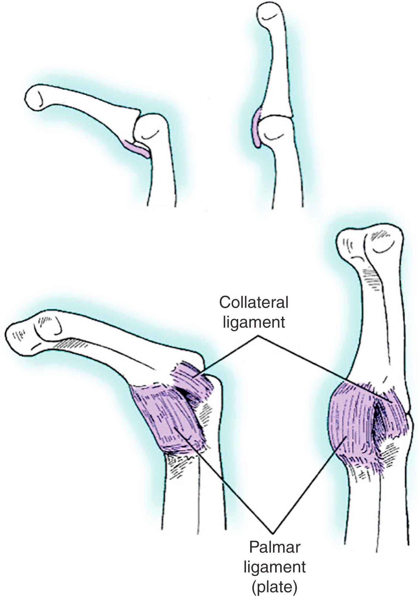 Fig. 77.1, Ball-in-cup design of metacarpophalangeal joint.