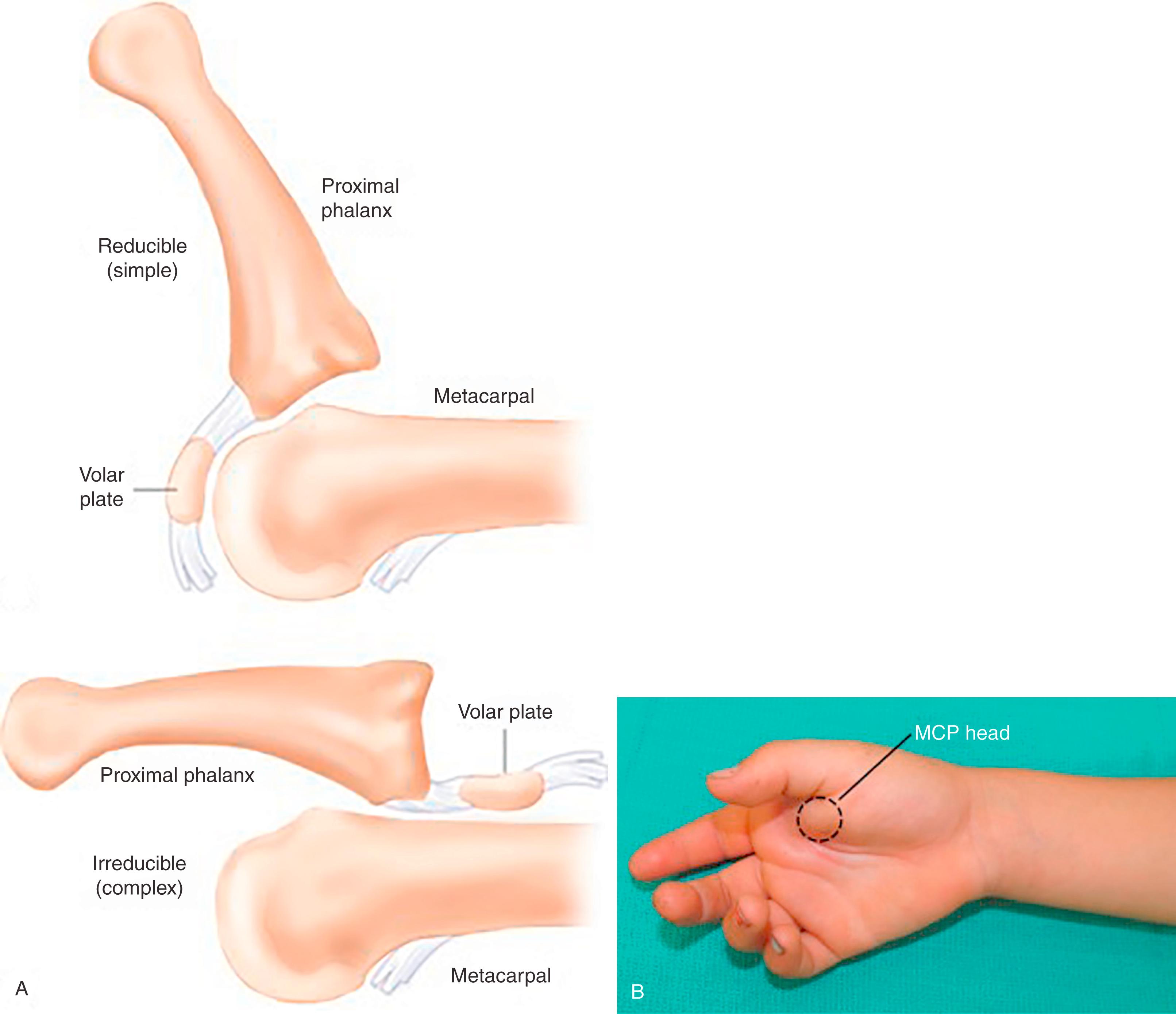 Fig. 77.3, Simple and complex metacarpophalangeal dislocation.