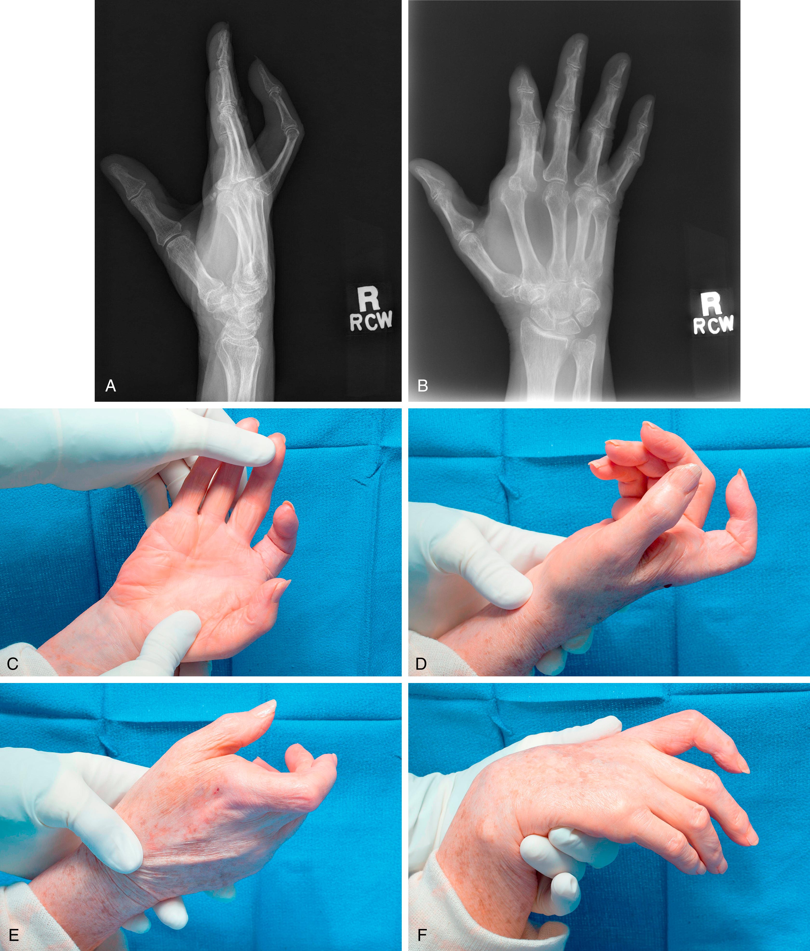 Fig. 77.4, Radiographic and clinical image of complex dorsal dislocation of the index finger. Note radiographic parallelism of index and metacarpal and relatively subtle clinical posturing of the digit.