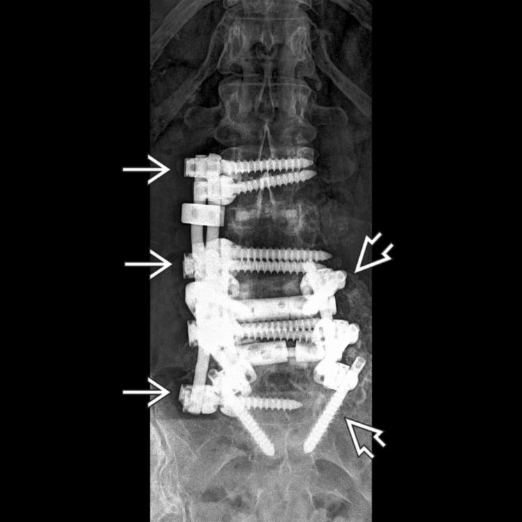 Plain film shows right lateral fusion extending from the L2-L5 with vertebral body screws and longitudinal rods, interbody graft material, and lower lumbar posterior pedicle screw fixation from L4-S1 .