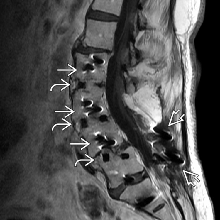 MR study in the same patient shows very little obscuration of the central canal by artifact, despite the amount of metal present. Metal artifact is present from lateral fusion and posterior fixation . Solid fusion with incorporated graft is noted by fatty disc space signal.