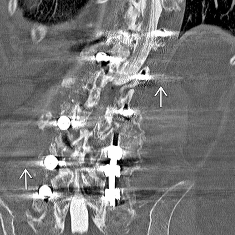 Coronal CT reconstruction illustrates bloom hardening artifact . Beam artifacts are a result of partial volume effects or underranging caused by areas of photon starvation propagated by high-density structures, such as metal, within the scanned object. When subtle, these artifacts appear as shading and, when severe, as high-intensity streaks and areas of photon starvation.