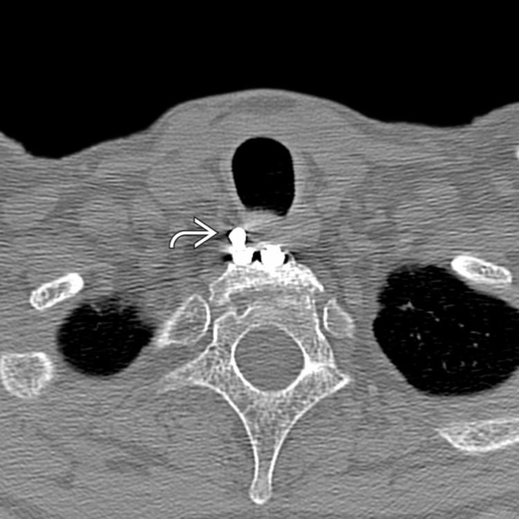 Axial NECT shows star artifact along the margins of the right corporal screw, which has migrated out .