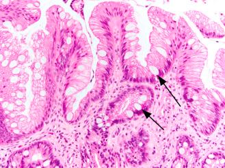 Figure 3.1, Barrett’s esophagus. The biopsy shows esophageal squamous mucosa that is replaced by glandular mucosa containing goblet cells (arrows).