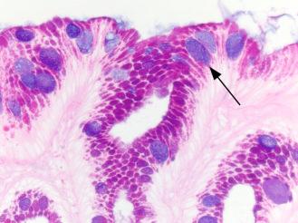 Figure 3.2, Periodic acid–Schiff (PAS)/Alcian blue at pH 2.5 demonstrates incomplete intestinal metaplasia. Goblet cells containing acid mucin stain intensely blue with Alcian blue (arrow), while the adjacent columnar cells containing neutral mucin stain with PAS (magenta staining cells within the epithelium).