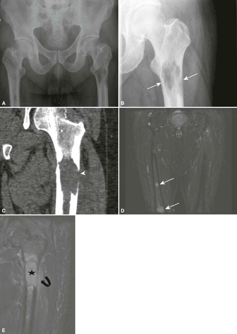 Figure 17-1, Metastatic disease involving bone with an impending pathologic fracture of the left femur in a 70-year-old man with lung carcinoma and left hip pain. Pelvis and frontal left hip radiographs ( A and B ) show lytic lesions in both proximal femurs, with the larger lesion involving the left peritrochanteric area and the entire femoral bone diameter with lateral cortical thinning at this site ( arrows in B ). The Mirels score is 12, corresponding to a high fracture risk requiring prophylatic treatment. Coronal CT ( C ) reveals similar features with extensive lateral cortical destruction ( arrowhead ). Coronal fat-suppressed T2-weighted magnetic resonance images (MRI; TR/TE = 4100/150) ( D and E ) demonstrate the marrow replacement of the left femur ( star ) and additional metastatic sites involving the right femur ( arrows ). A small periosteal cuff of edema laterally ( curved arrow ) represents the impending pathologic fracture on MRI.
