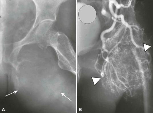 Figure 17-2, Thyroid cancer metastatic disease with a marked expansile lesion (“blowout” lesion) involving the ischial region ( arrows ) on an oblique hip radiograph ( A ). There is marked hypervascularity ( arrowheads ) on the arteriogram ( B ).