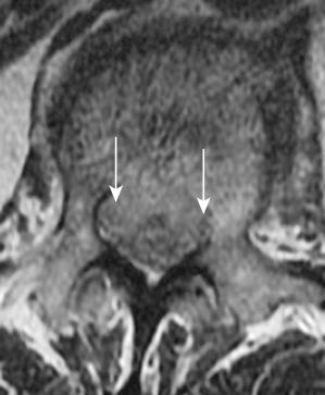 Fig. 51.1, This sagittal T2-weighted magnetic resonance image was taken of a female patient who described bilateral groin pain. Images of her hips were negative. This pathologic fracture at L1 was causing compression of her exiting nerve roots. Subsequent biopsy revealed metastatic carcinoma.