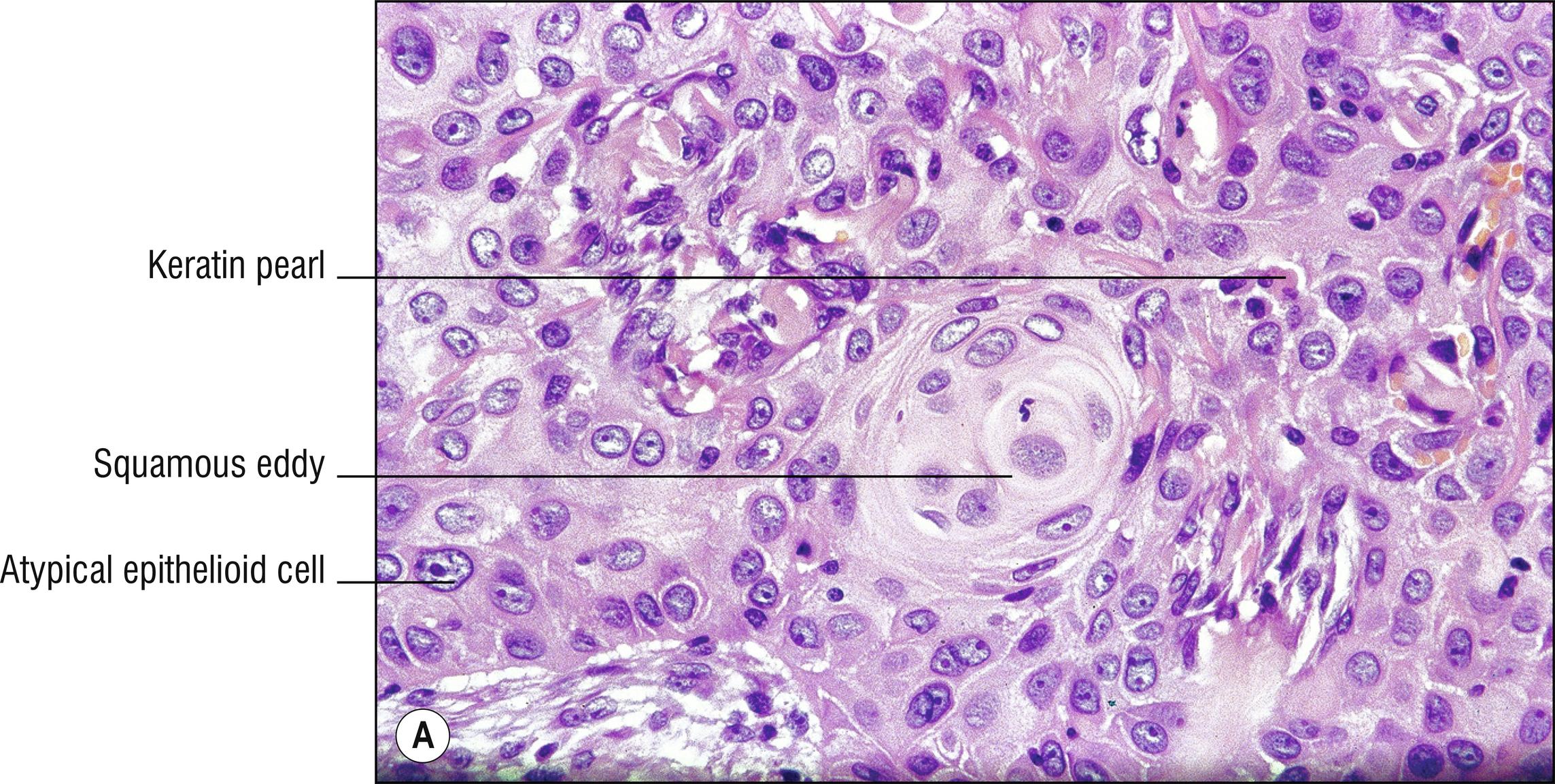 Fig. 28.1, A Metastatic squamous cell carcinoma.