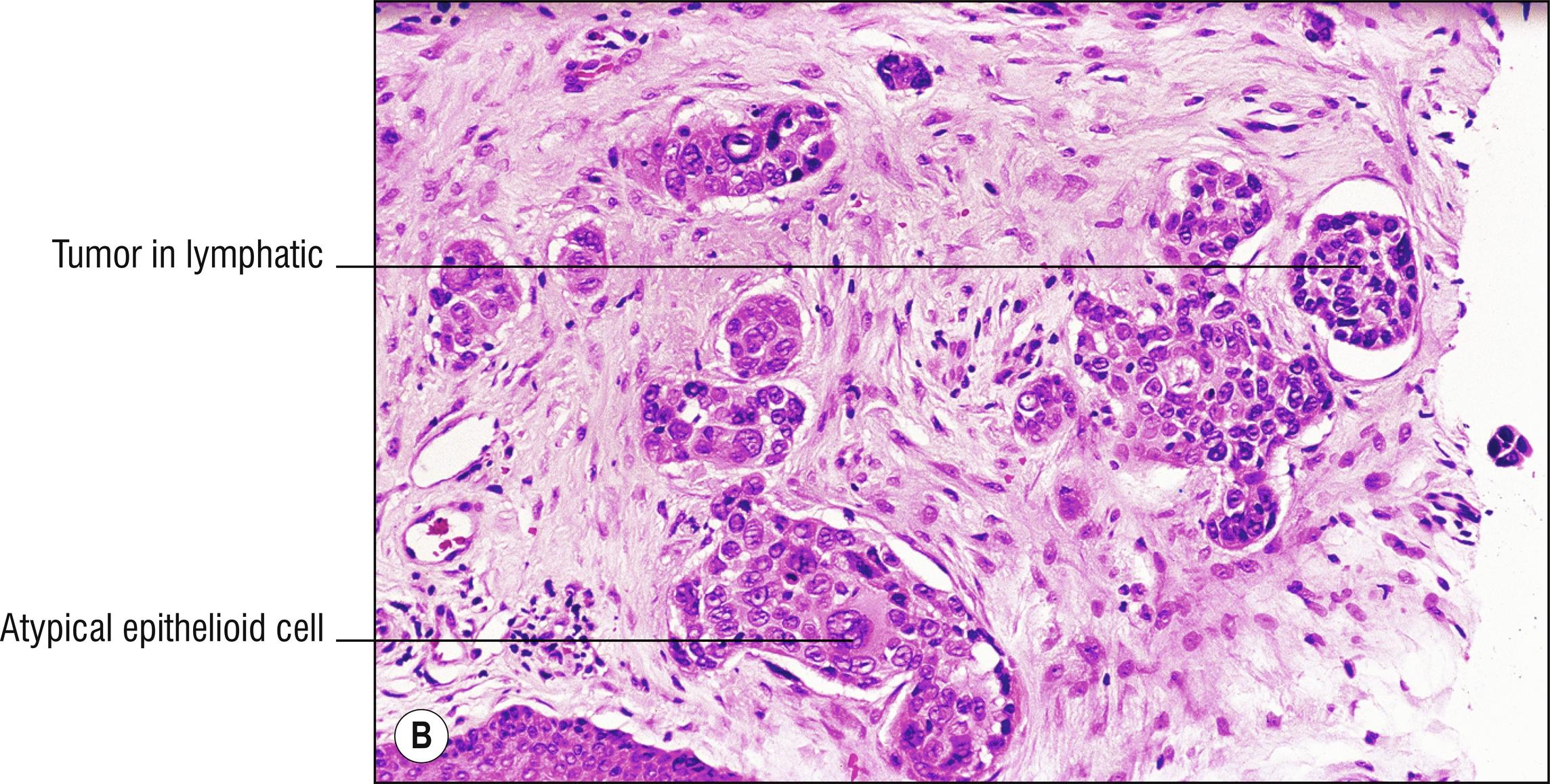 Fig. 28.1, B Metastatic squamous cell carcinoma (in lymphatics).