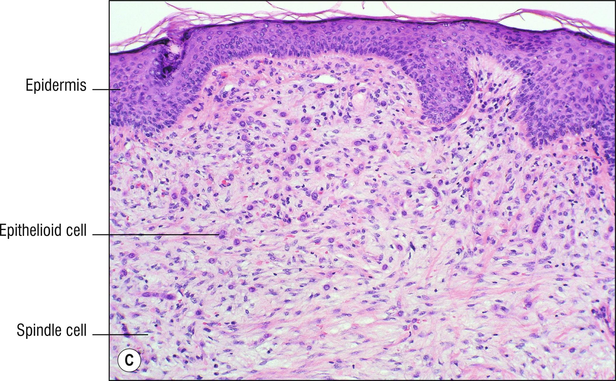 Fig. 28.1, C Poorly differentiated metastatic carcinoma in dermis.