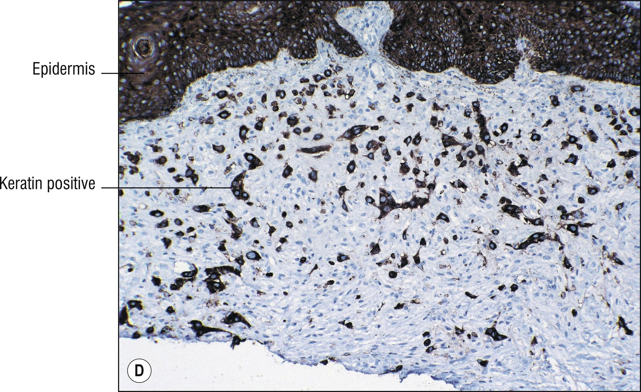 Fig. 28.1, D Same carcinoma seen in Fig. 28.1C , stained with pankeratin.