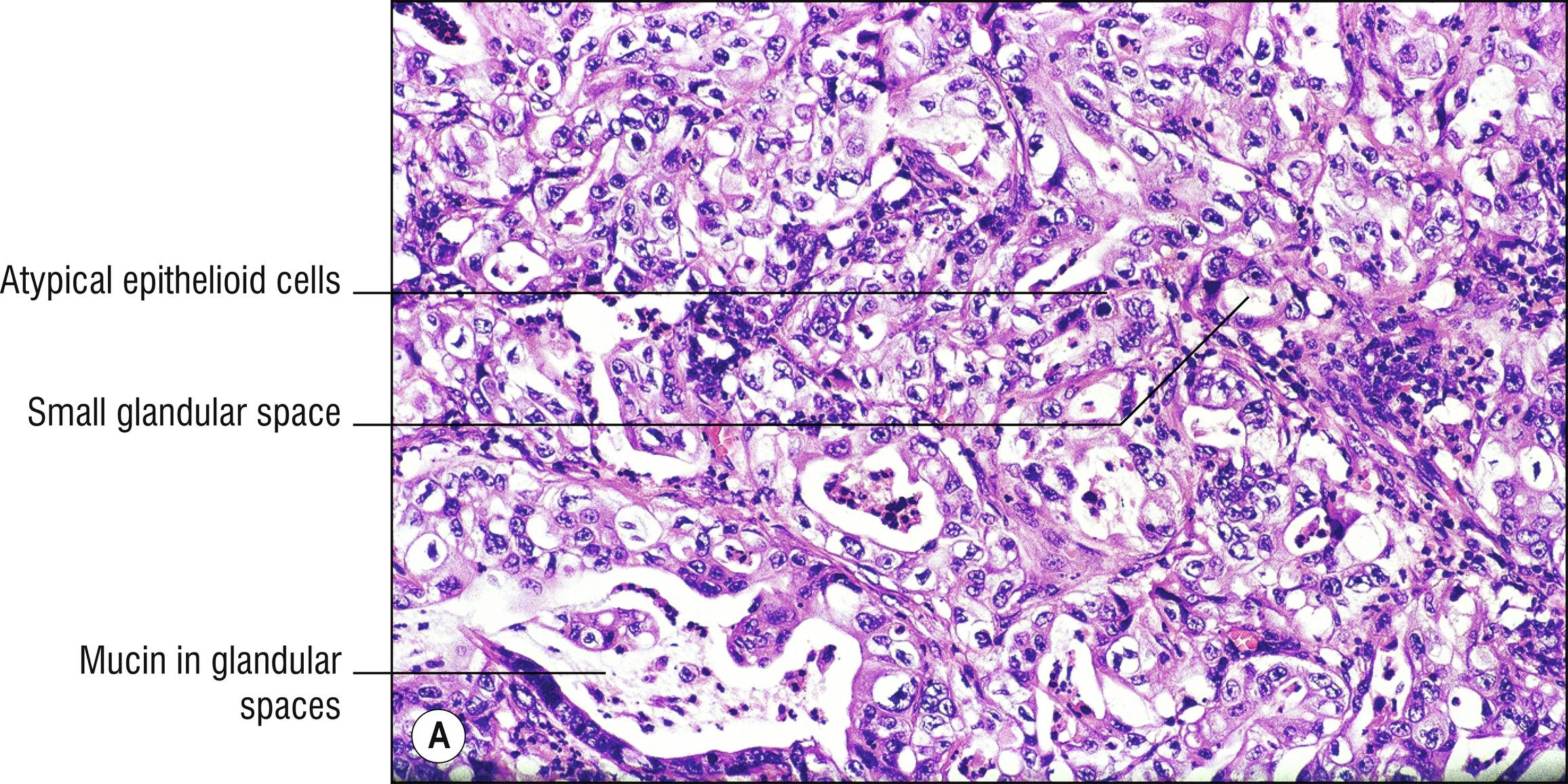 Fig. 28.2, A Metastatic adenocarcinoma from colon.