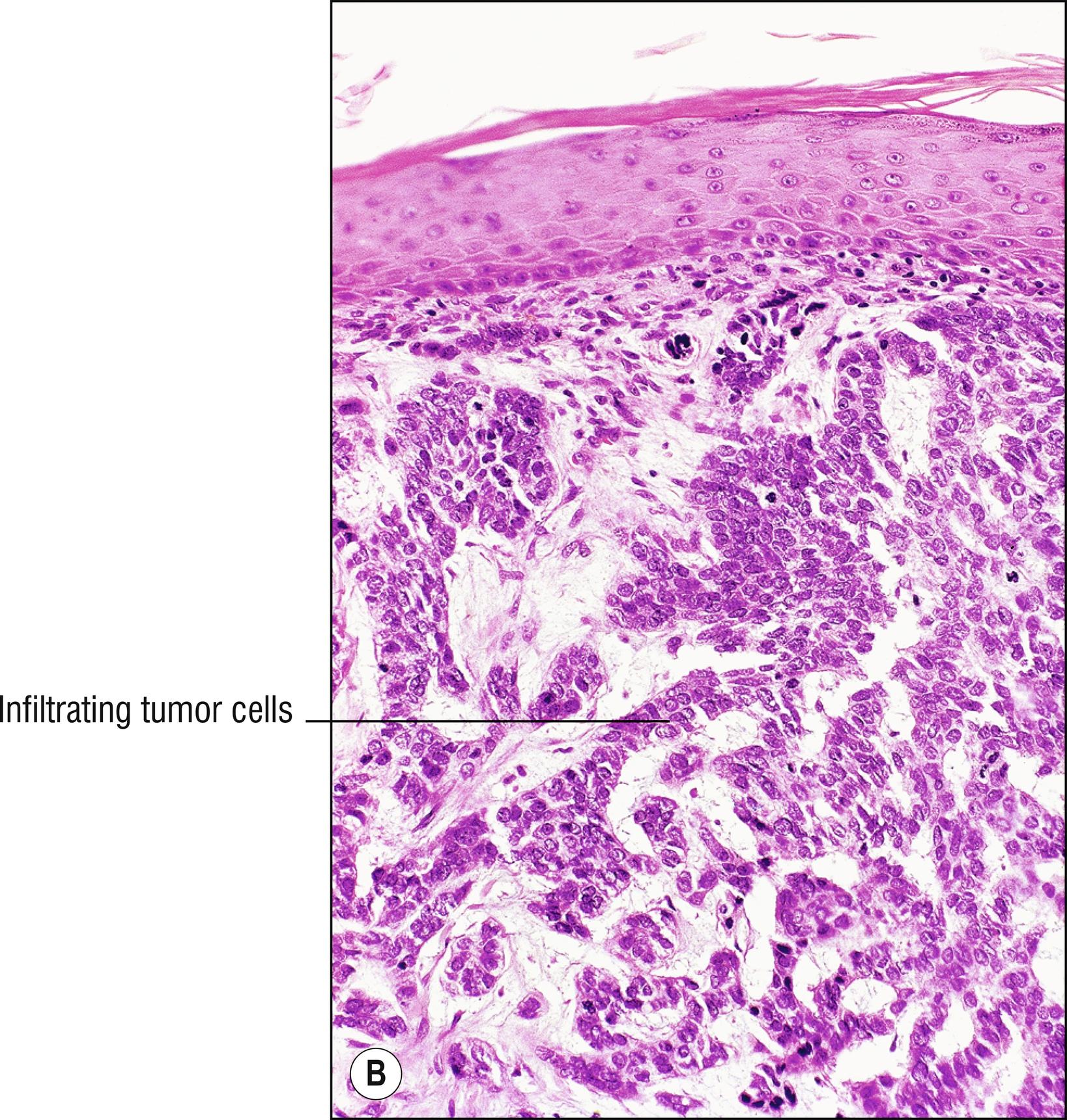 Fig. 28.2, B Metastatic adenocarcinoma from prostate.