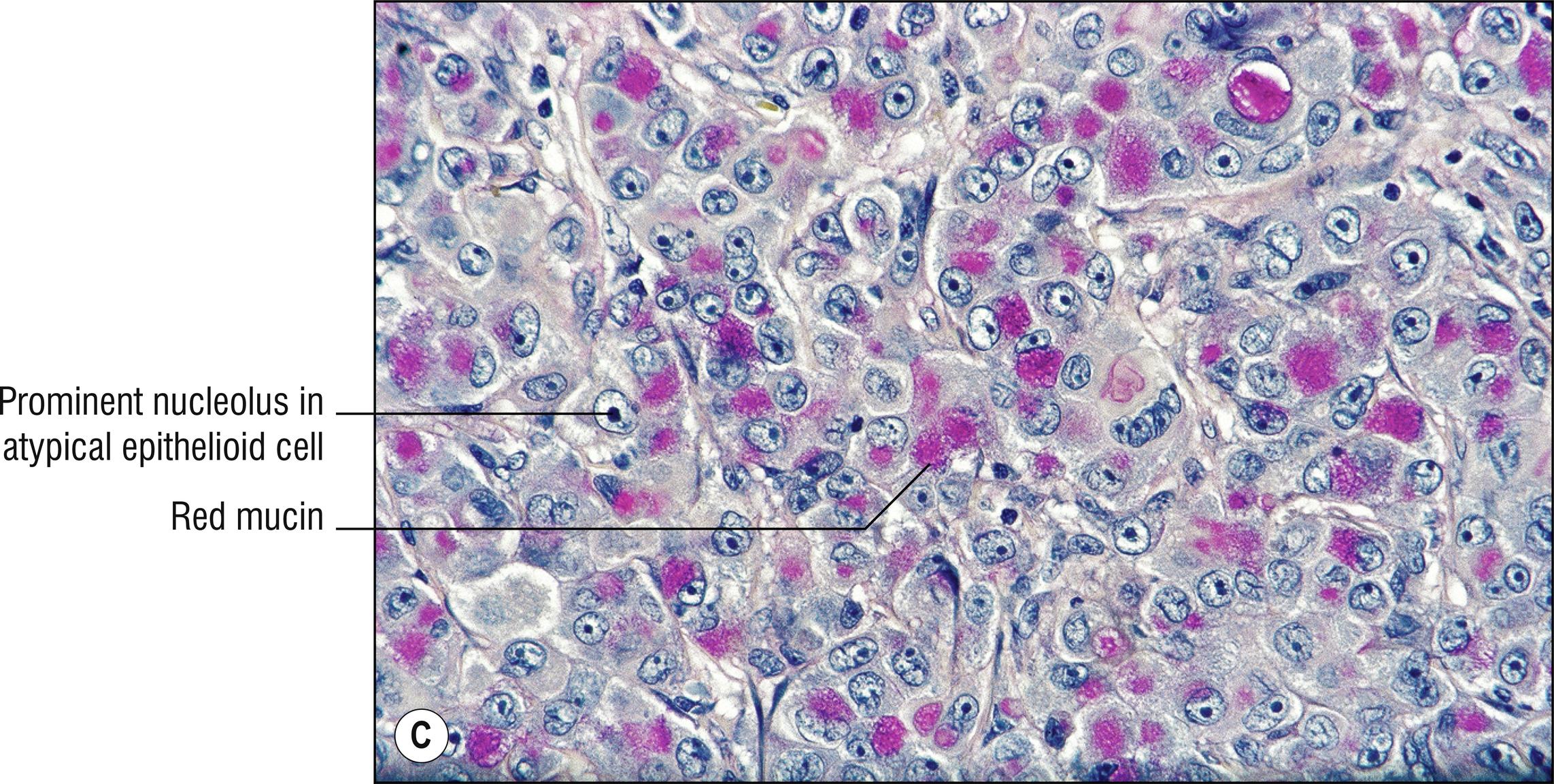 Fig. 28.2, C Metastatic adenocarcinoma (mucicarmine stain).