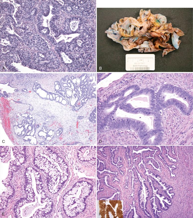 Fig. 28.2, Metastatic cervical adenocarcinoma. A, A high-grade tumor, with both glandular and more solid areas. Note the juxtaposition of both eosinophilic areas (mucin) and high-grade nuclei. B, A sectioned fixed cystic ovarian tumor found to be a metastatic cervical adenocarcinoma. C, A well-differentiated metastatic adenocarcinoma. D, Note the apical eosinophilia with suspended mitoses. E, Metastatic cervical adenocarcinoma with an intestinal pattern. F, Metastatic cervical adenocarcinoma involving tubal mucosa. There is strong staining for p16 (inset).