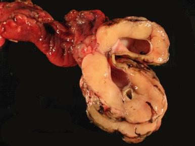 Fig. 28.3, Gross photograph of metastatic gastric carcinoma (Kruken-berg tumor) with characteristic uniform consistency and replacement of the ovarian cortex.