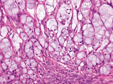 Fig. 28.4, A, Metastatic gastric carcinoma (Krukenberg tumor) with numerous signet ring cells. B, Metastatic gastric carcinoma (Krukenberg tumor) with signet ring cells in cords and trabeculae.