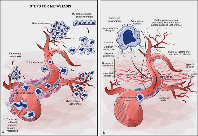 FIGURE 19-1, Major biologic phenomena associated with tumor progression and metastasis.