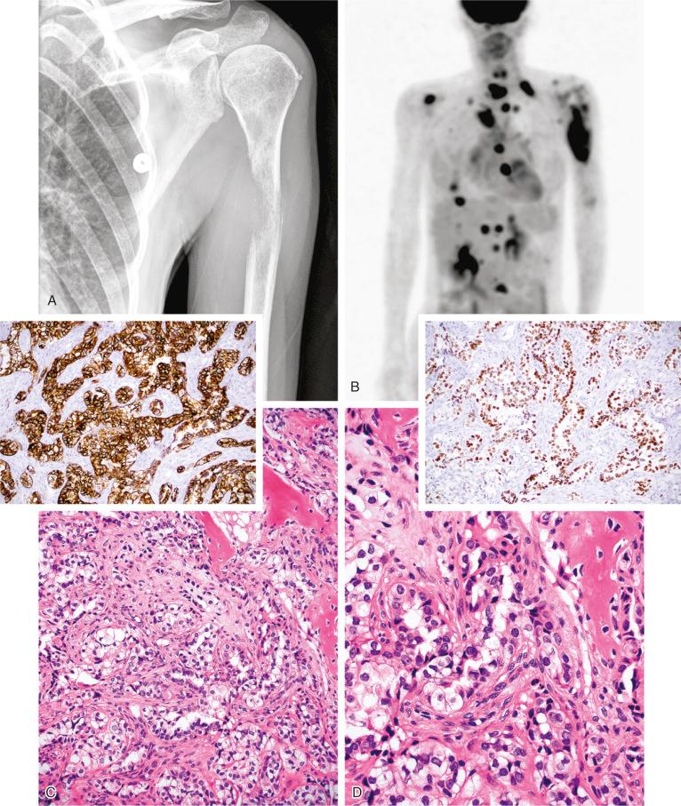 FIGURE 19-11, Lytic pulmonary adenocarcinoma metastasis in humerus: radiographic, microscopic, and immunohistochemical features.