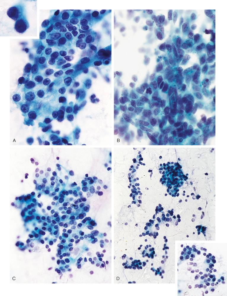 FIGURE 19-12, Metastatic carcinoma of the lung and follicular carcinoma of the thyroid: cytologic features.