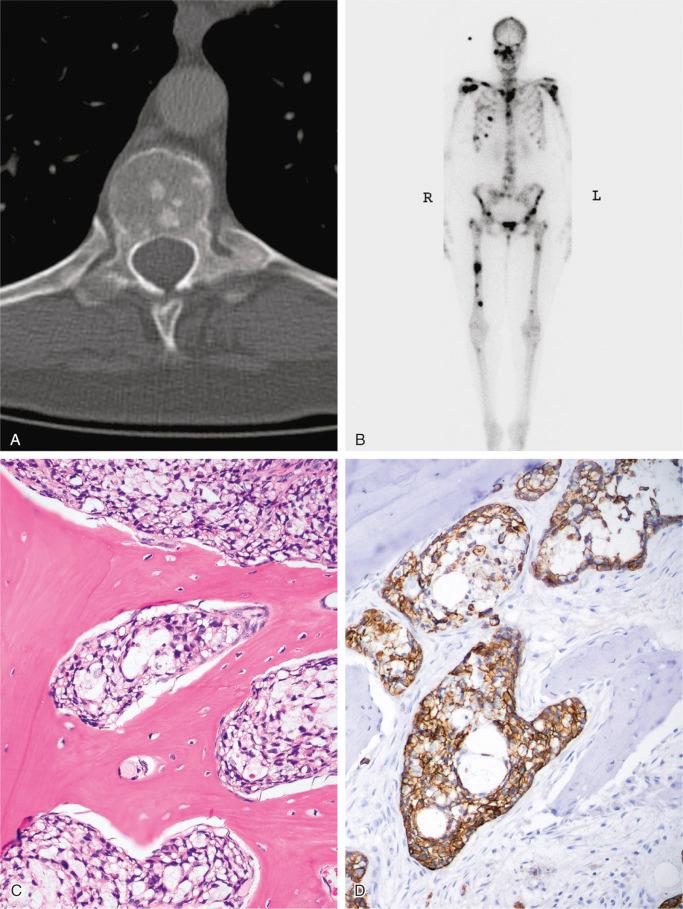 FIGURE 19-13, Widespread blastic gastric adenocarcinoma metastases: radiographic, microscopic, and immunohistochemical features.