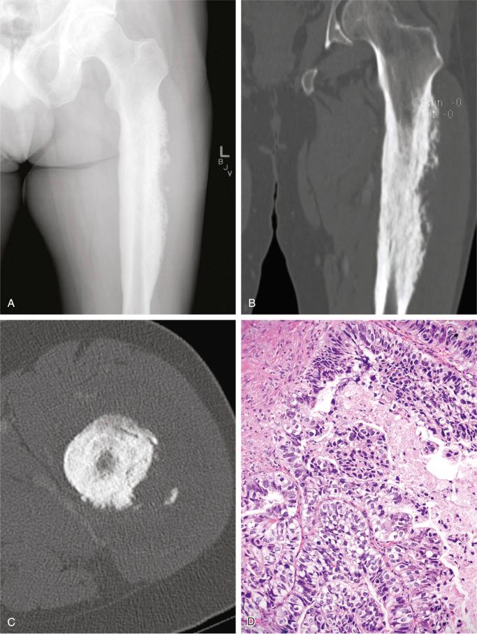 FIGURE 19-14, Metastatic esophageal adenocarcinoma in femur: radiographic and microscopic features.