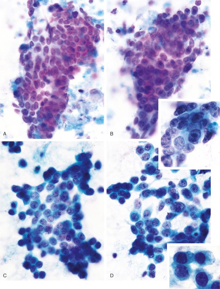 FIGURE 19-15, Colonic and breast carcinomas metastatic to bone: cytologic features.