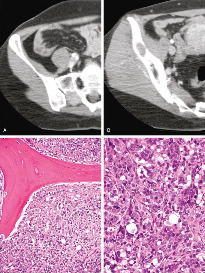 FIGURE 19-16, Metastatic breast carcinoma: radiographic and microscopic features.