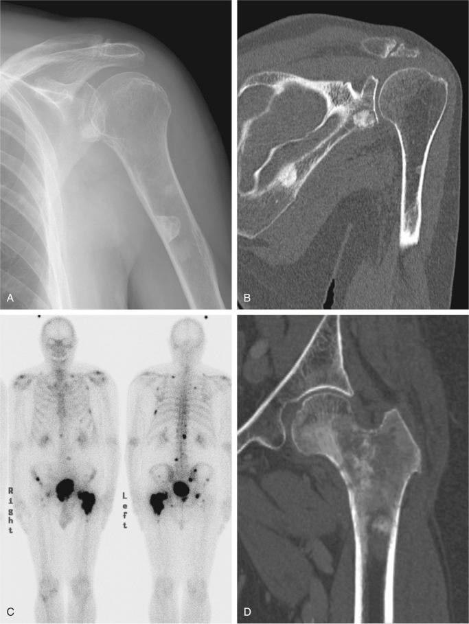 FIGURE 19-4, Widespread osteoblastic skeletal metastases in prostate adenocarcinoma: radiographic features.