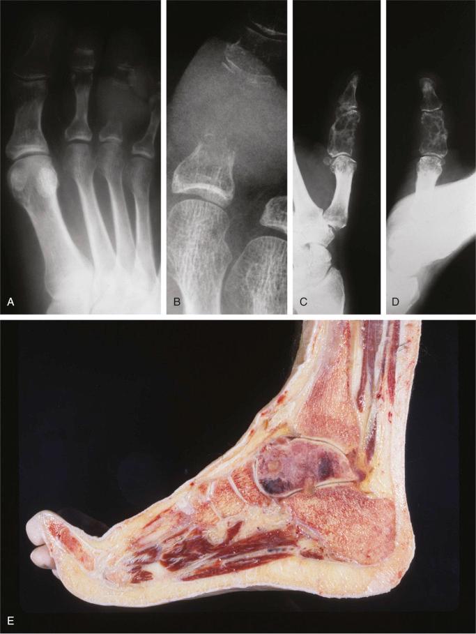 FIGURE 19-6, Acral metastases: gross and radiographic features.