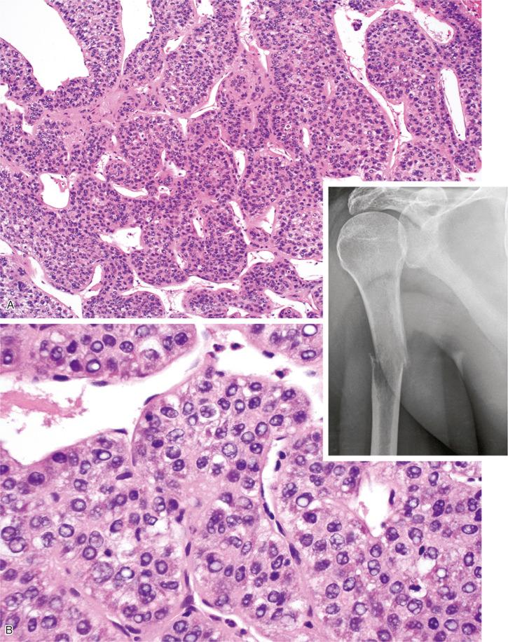 FIGURE 19-7, Metastatic carcinoma with pathologic fracture: radiographic and histologic features.